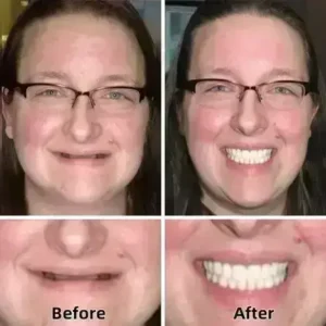 SmileFitPro™–Advanced Custom-Fit Functional Dentures