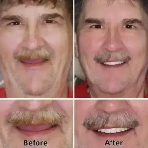 SmileFitPro™–Advanced Custom-Fit Functional Dentures